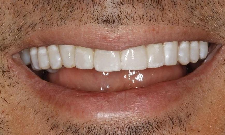 Porcelain Veneers Before & After Photos North Miami FL